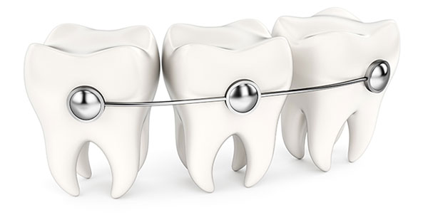 Braces Downey CA